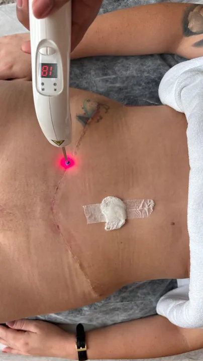 Caneta de laser terapêutico aplicada sobre uma cicatriz